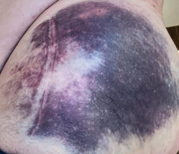 Bruise